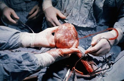 heart-transplantation.jpg